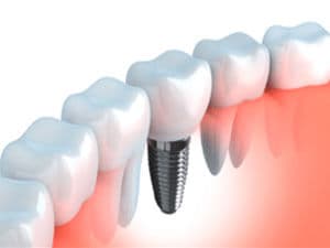 tooth implant