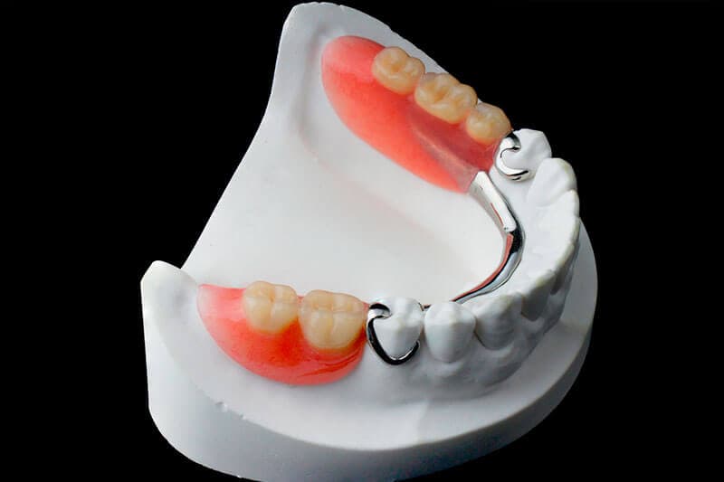 Affordable Partial Dentures in Chino Hills, CA (Free Consultations)