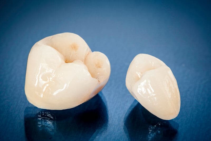 provisional restorations