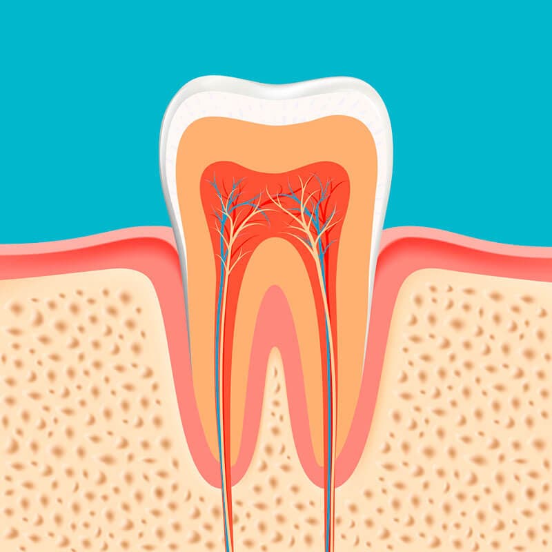 Root canal illustration